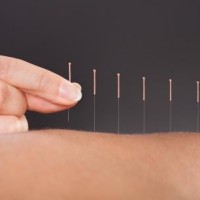 Kunne du tænke dig at prøve akupunktur?