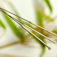 Iskiassmerter kan fjernes med akupunktur.